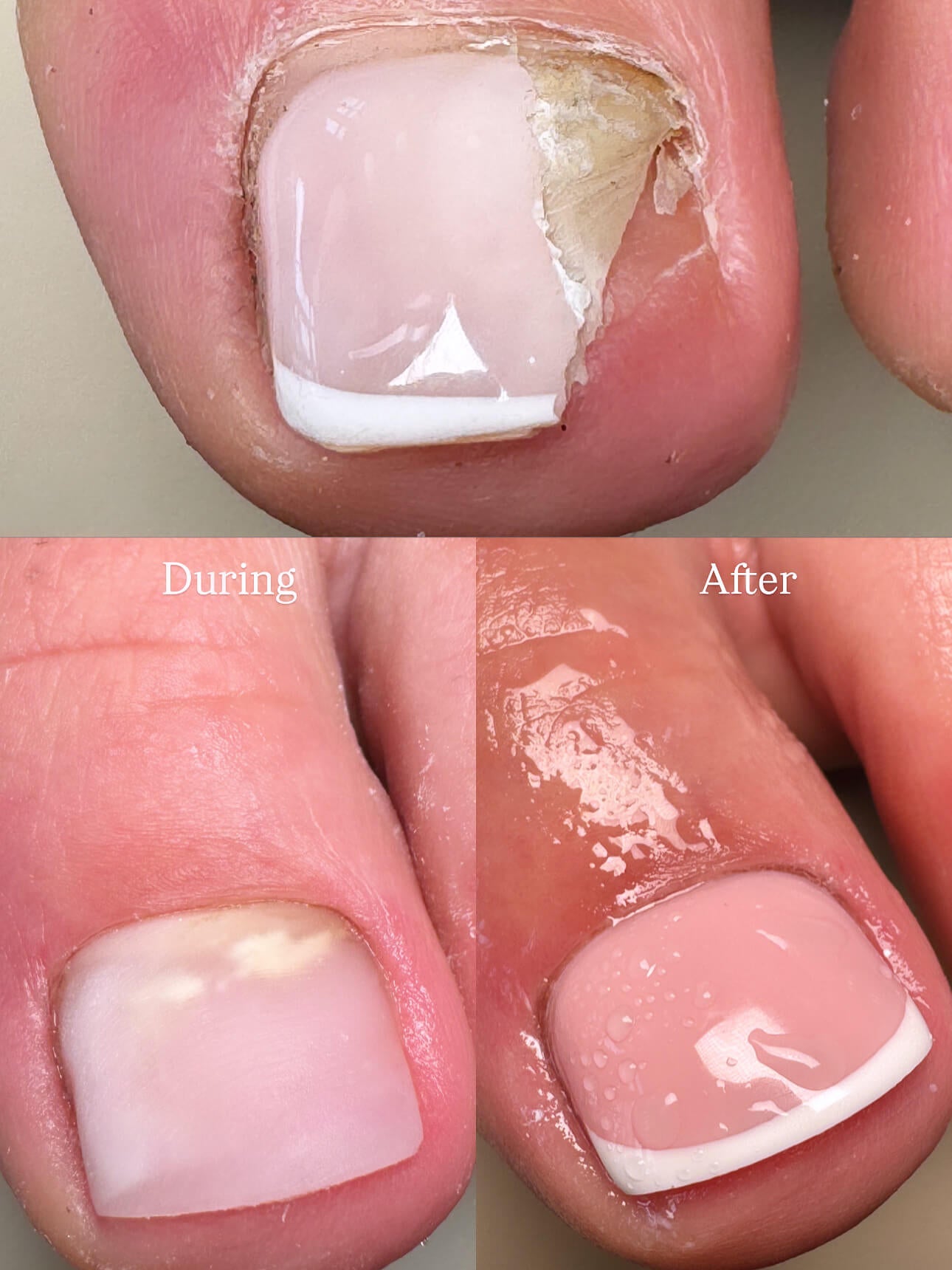Toenail Reconstruction Course
